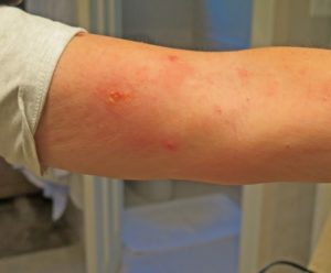 Red welts from fleas biting an arm